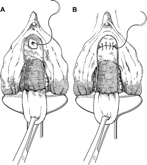 Reconstructive surgery of male urethra using human amnion。